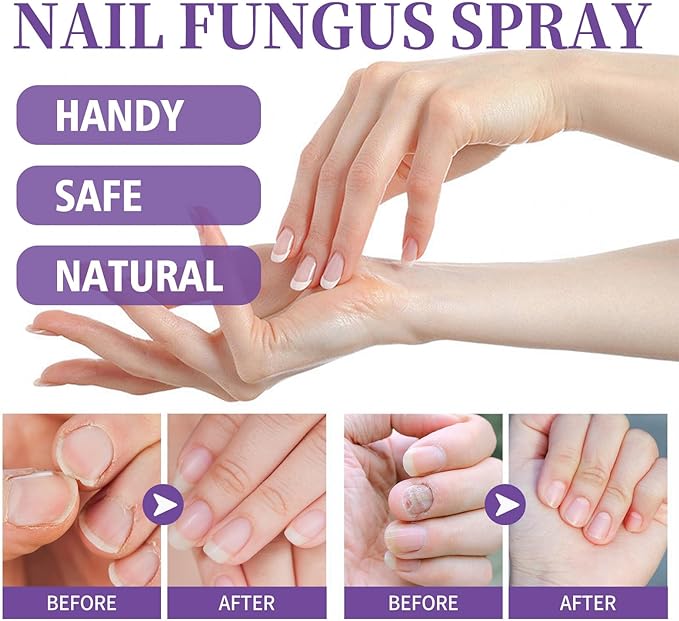 Nail Fungus Spray x24 pieces